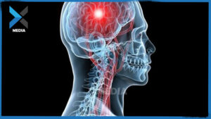 علاج سريع لكشف السكتات الدماغية